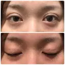 二重埋没 湘南美容クリニック 新宿南口院 DAY 10 サムネイル用