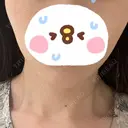 脂肪溶解注射（顔） LIGHT CLINIC 【ライトクリニック】 名古屋院 DAY 2 サムネイル用