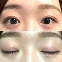 二重埋没 水の森美容クリニック 大阪梅田院 DAY 369 サムネイル用