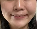 ピーリング（ニキビ・毛穴） / ピーリング（ハリ・ツヤ） MKクリニック 日本橋院 AFTER サムネイル用