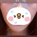 脂肪溶解注射（顔） LIGHT CLINIC 【ライトクリニック】 名古屋院 DAY 4 サムネイル用