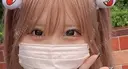 ヒアルロン酸注入（目の下） 宇都宮ひふ科形成外科 DAY 0 サムネイル用