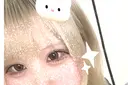ヒアルロン酸注入（目の下） 宇都宮ひふ科形成外科 AFTER サムネイル用