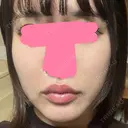 ヒアルロン酸注入（唇） / ボトックス（口角） / ヒアルロン酸注入（頬） KAGA CLINIC DAY 0 サムネイル用