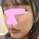 ヒアルロン酸注入（唇） / ボトックス（口角） / ヒアルロン酸注入（頬） KAGA CLINIC DAY 0 サムネイル用