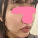 ヒアルロン酸注入（唇） / ボトックス（口角） / ヒアルロン酸注入（頬） KAGA CLINIC DAY 0 サムネイル用