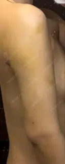 脂肪吸引（二の腕） / 脂肪吸引（肩） 湘南美容クリニック 渋谷院 DAY 6 サムネイル用