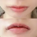 口唇縮小術 B-LINE CLINIC 池袋院 DAY 3 サムネイル用