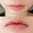 口唇縮小術 B-LINE CLINIC 池袋院 DAY 4 サムネイル用