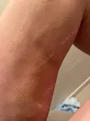 脂肪吸引（脚） / 豊胸（脂肪注入） GAYA body design clinic DAY 18 サムネイル用