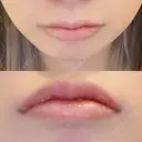 口唇縮小術 B-LINE CLINIC 池袋院 DAY 5 サムネイル用