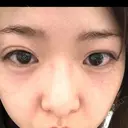 ヒアルロン酸注入（涙袋） Olino美容外科・美容皮膚科 AFTER サムネイル用