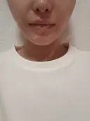 小鼻縮小（切開） / 人中短縮 / 口角挙上 / その他（口元） オザキクリニック LUXE新宿 AFTER サムネイル用