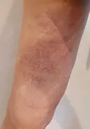 クマ治療 / 脂肪注入（目の下） あじまビューティークリニック DAY 1 サムネイル用