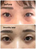 下まぶたの脂肪取り / 脂肪注入（目の下） セオリークリニック AFTER サムネイル用