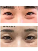 下まぶたの脂肪取り / 脂肪注入（目の下） セオリークリニック DAY 95 サムネイル用