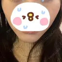 脂肪溶解注射（顔） LIGHT CLINIC 【ライトクリニック】 名古屋院 DAY 7 サムネイル用