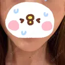 脂肪溶解注射（顔） LIGHT CLINIC 【ライトクリニック】 名古屋院 AFTER サムネイル用