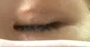 二重埋没 Olino美容外科・美容皮膚科 DAY 15 サムネイル用