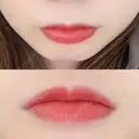 口唇縮小術 B-LINE CLINIC 池袋院 DAY 8 サムネイル用