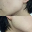 ボトックス（エラ・小顔） TCB東京中央美容外科 福岡博多院 DAY 6 サムネイル用