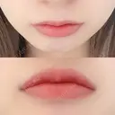 口唇縮小術 B-LINE CLINIC 池袋院 DAY 9 サムネイル用