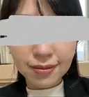 ハイフ（顔） プラチナクリニック DAY 4 サムネイル用