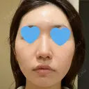 ポテンツァ LOUIS CLINIC 二子玉川院【ルイクリニック】 AFTER サムネイル用