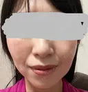 ハイフ（顔） プラチナクリニック DAY 6 サムネイル用