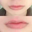 口唇縮小術 B-LINE CLINIC 池袋院 DAY 13 サムネイル用