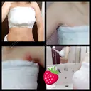 豊胸（シリコンバッグ） 湘南美容クリニック 名古屋栄院 DAY 3 サムネイル用