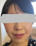 ハイフ（顔） プラチナクリニック DAY 11 サムネイル用