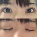 二重切開 / 目元修正 ルネッサンス美容外科医院 神戸院 DAY 51 サムネイル用