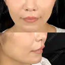 ヒアルロン酸注入（鼻翼基部） 藤・ナチュレ美容クリニック 恵比寿院 AFTER サムネイル用