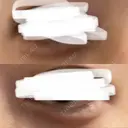 鼻翼基部形成（貴族手術） / ヒアルロン酸注入（涙袋） ルラ美容クリニック 大阪本院 DAY 0 サムネイル用