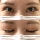 二重埋没 Olino美容外科・美容皮膚科 DAY 28 サムネイル用