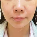 シミ取りレーザー ももスキンケアクリニック DAY 7 サムネイル用