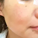 シミ取りレーザー ももスキンケアクリニック DAY 7 サムネイル用