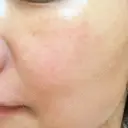 シミ取りレーザー ももスキンケアクリニック DAY 7 サムネイル用