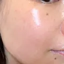 シミ取りレーザー ももスキンケアクリニック DAY 8 サムネイル用