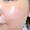 シミ取りレーザー ももスキンケアクリニック DAY 8 サムネイル用