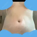 脂肪冷却（お腹） 美容皮膚科エルムクリニック 大阪院 AFTER サムネイル用