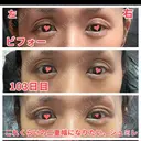 二重切開 / 眼瞼下垂（切開） / 上まぶたたるみ取り 心斎橋形成外科スキンケアクリニック DAY 104 サムネイル用