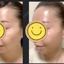 脂肪吸引（顔） / 脂肪注入（肌） / ヒアルロン酸注入（あご） / ボトックス（エラ・小顔） / ダーマペン Mods Clinic（モッズクリニック） 大阪院 AFTER サムネイル用
