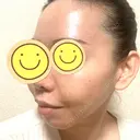 脂肪吸引（顔） / 脂肪注入（肌） / ヒアルロン酸注入（あご） / ボトックス（エラ・小顔） / ダーマペン Mods Clinic（モッズクリニック） 大阪院 DAY 176 サムネイル用