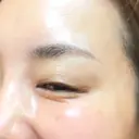 その他（目元） ももスキンケアクリニック DAY 10 サムネイル用