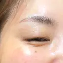 その他（目元） ももスキンケアクリニック DAY 10 サムネイル用