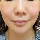 シミ取りレーザー ももスキンケアクリニック AFTER サムネイル用