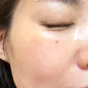 シミ取りレーザー ももスキンケアクリニック DAY 10 サムネイル用