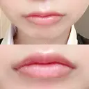 口唇縮小術 B-LINE CLINIC 池袋院 AFTER サムネイル用